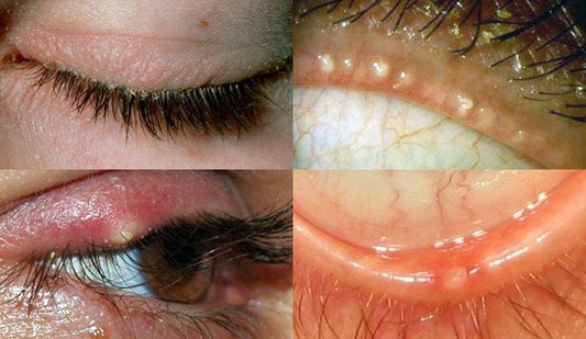 Bilder av ulike øyne med dårlig vippehygiene
